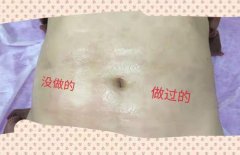 去妊娠紋機器多少錢一臺？美容院去除妊娠紋機器設(shè)備價格
